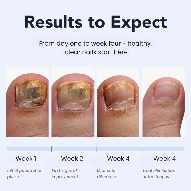 Anti-Fungal Nail Pen