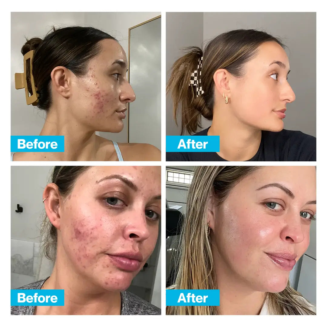 Clear Skin